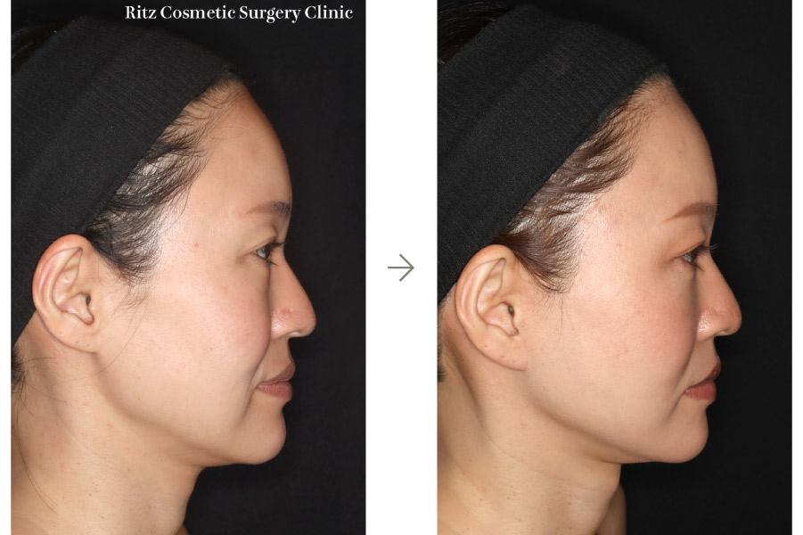 症例写真：フェイスネックリフト（Extended Deep Plane Facelift） 裏ハムラ法