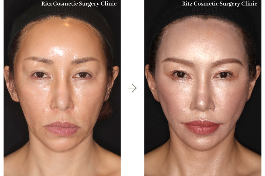 症例写真：フェイスネックリフト（Extended Deep Plane Facelift）