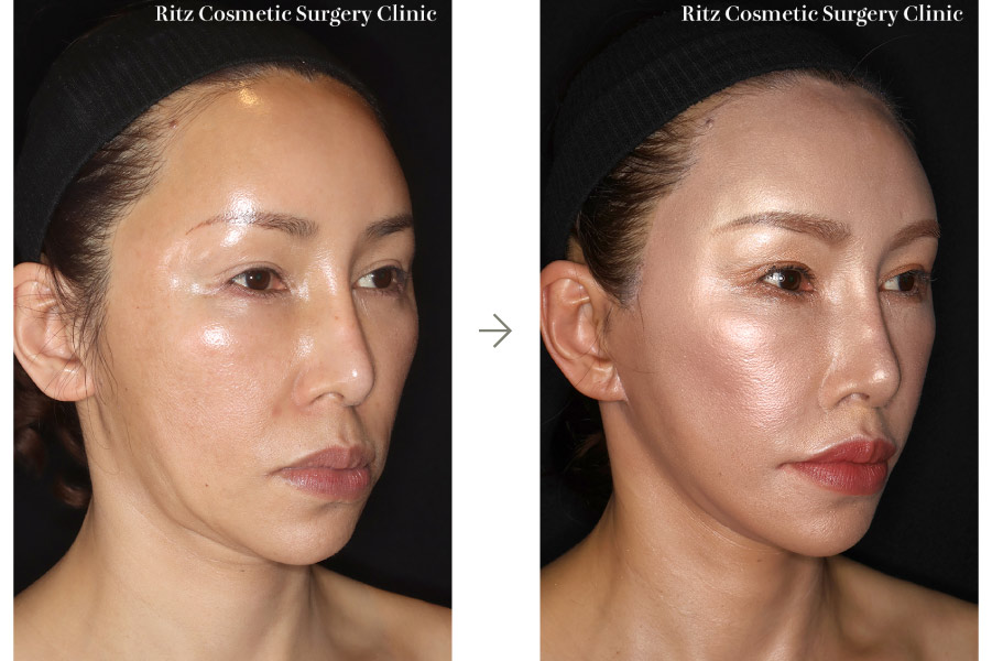 症例写真：フェイスネックリフト（Extended Deep Plane Facelift）