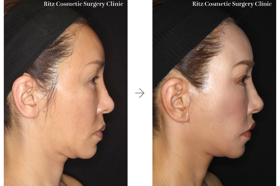 症例写真：フェイスネックリフト（Extended Deep Plane Facelift）