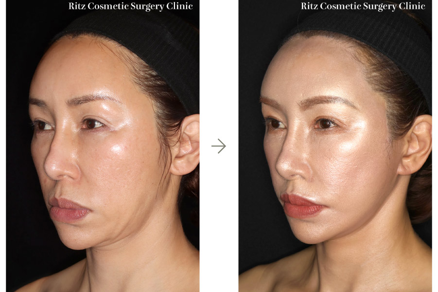 症例写真：フェイスネックリフト（Extended Deep Plane Facelift）
