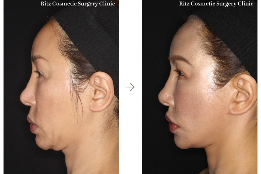 症例写真：フェイスネックリフト（Extended Deep Plane Facelift）