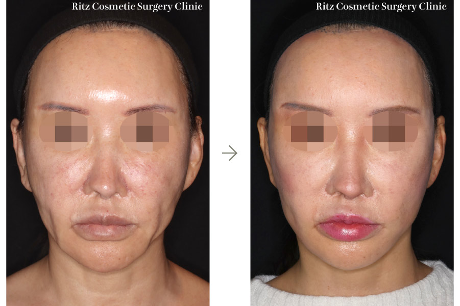 症例写真：フェイスネックリフト（Extended Deep Plane Facelift）