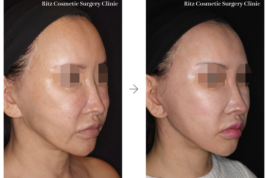 症例写真：フェイスネックリフト（Extended Deep Plane Facelift）