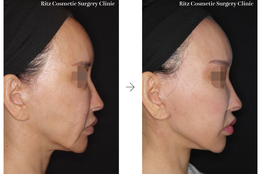 症例写真：フェイスネックリフト（Extended Deep Plane Facelift）