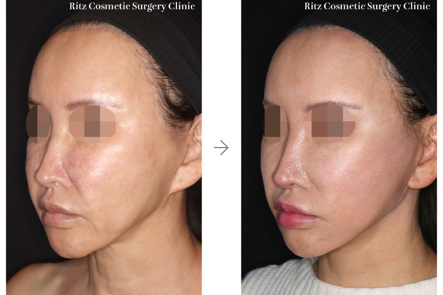 症例写真：フェイスネックリフト（Extended Deep Plane Facelift）