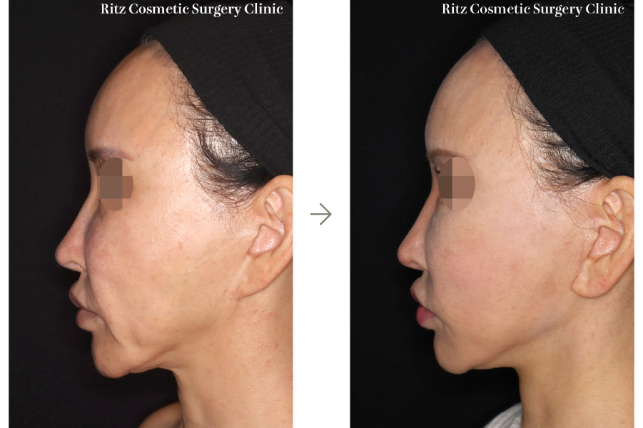 症例写真：フェイスネックリフト（Extended Deep Plane Facelift）