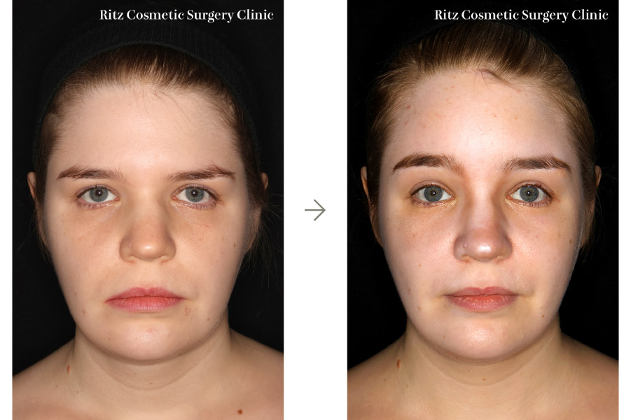 症例写真:内視鏡ブロウリフト