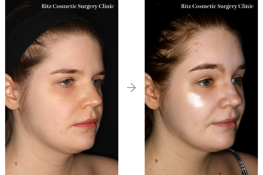 症例写真:内視鏡ブロウリフト