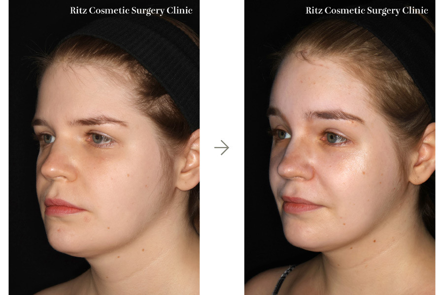 症例写真:内視鏡ブロウリフト