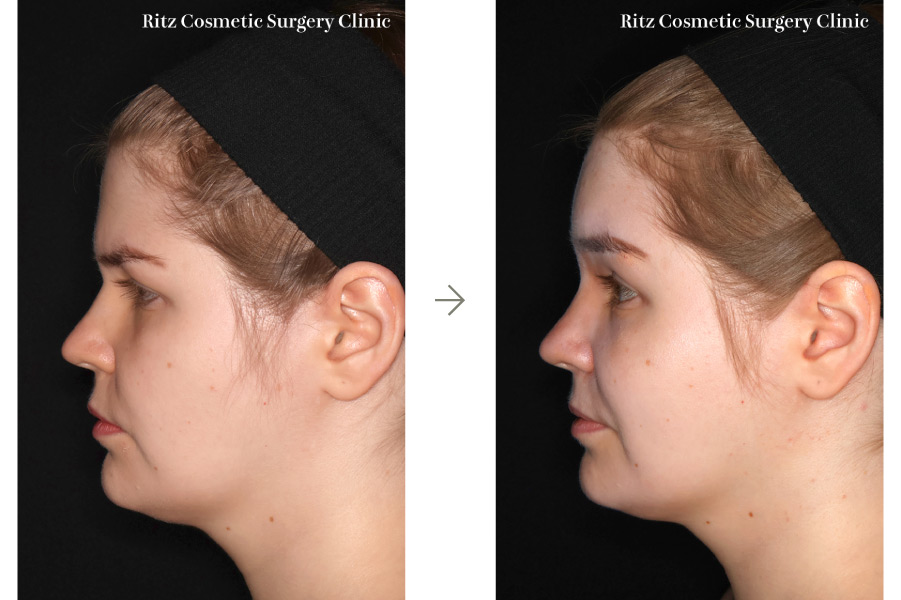 症例写真:内視鏡ブロウリフト