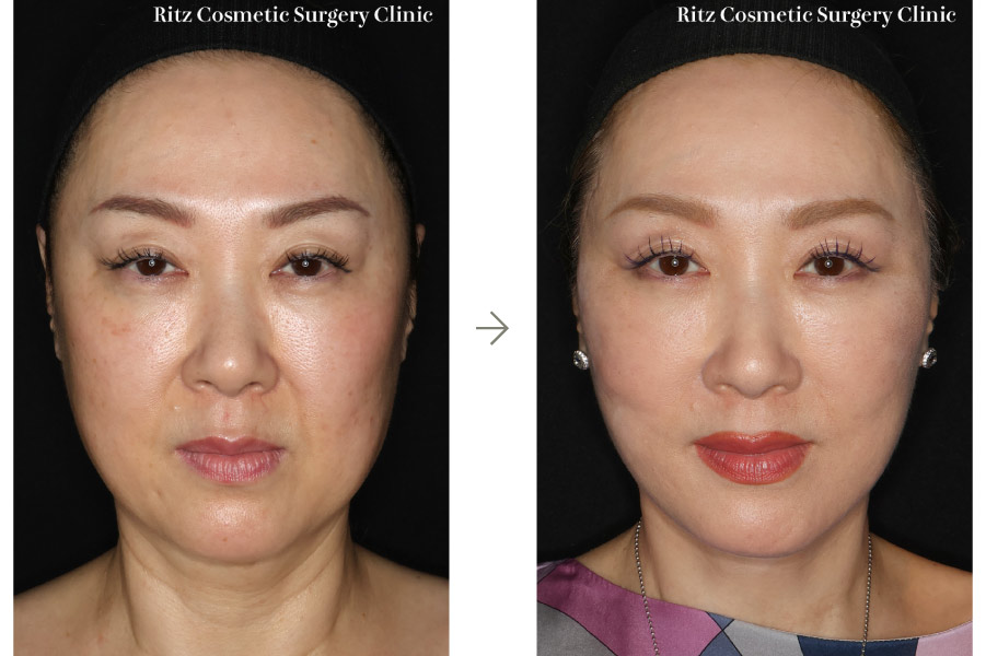 症例写真：フェイスネックリフト（Extended Deep Plane Facelift）ペリカン手術 脂肪吸引(ジョールファット)