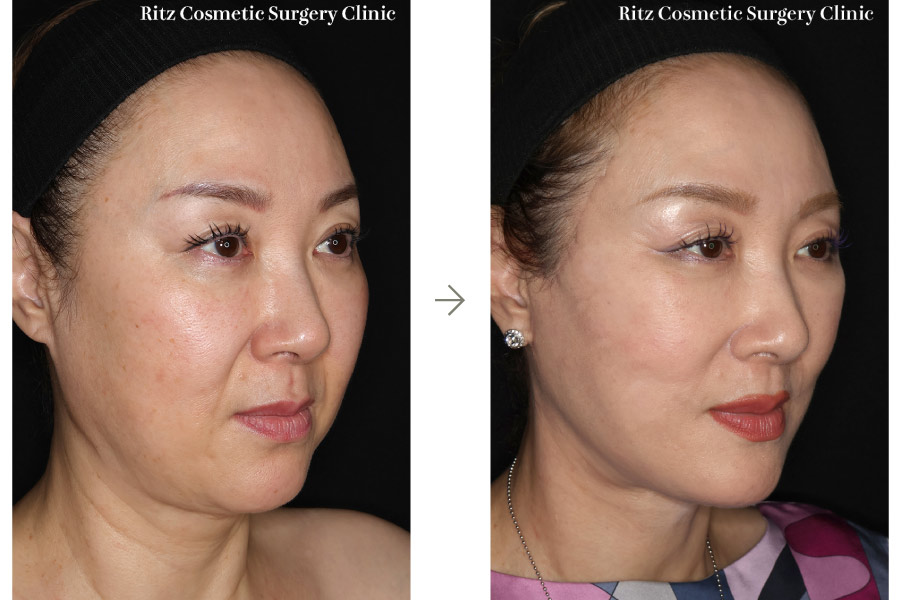 症例写真：フェイスネックリフト（Extended Deep Plane Facelift）ペリカン手術 脂肪吸引(ジョールファット)