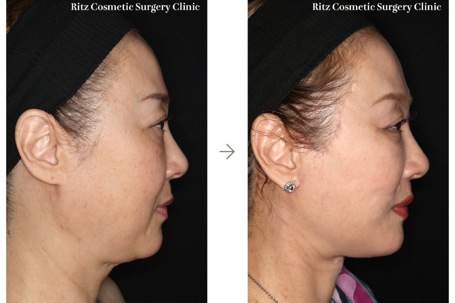 症例写真：フェイスネックリフト（Extended Deep Plane Facelift）ペリカン手術 脂肪吸引(ジョールファット)