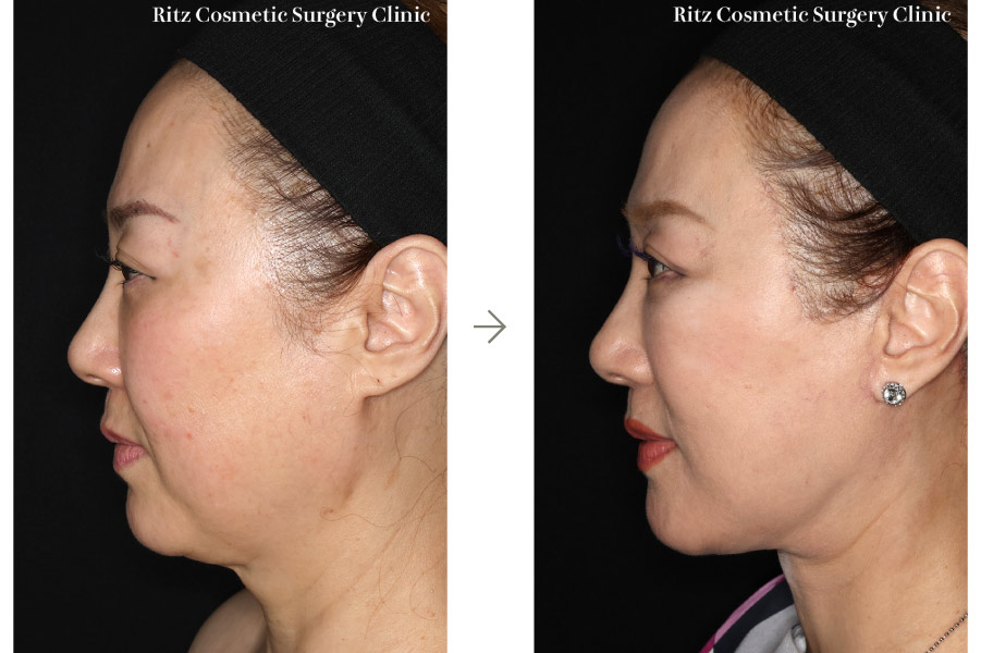 症例写真：フェイスネックリフト（Extended Deep Plane Facelift）ペリカン手術 脂肪吸引(ジョールファット)