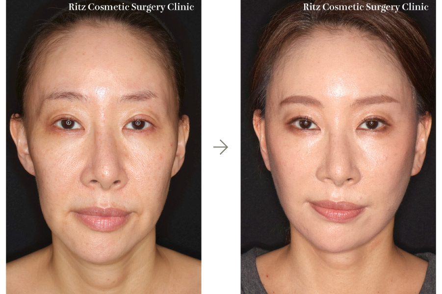 症例写真：フェイスネックリフト（Extended Deep Plane Facelift） ペリカン手術 脂肪吸引(ジョールファット)