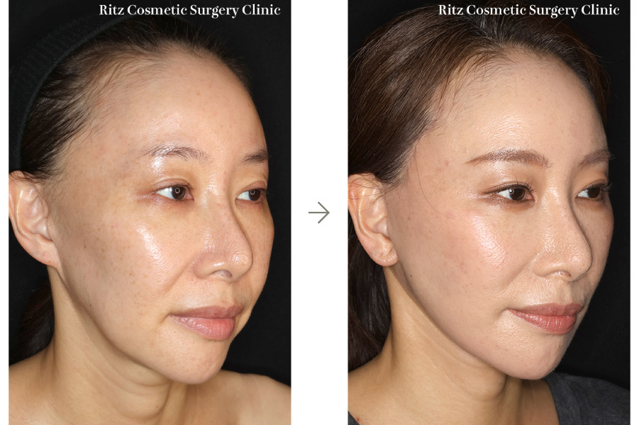 症例写真：フェイスネックリフト（Extended Deep Plane Facelift） ペリカン手術 脂肪吸引(ジョールファット)