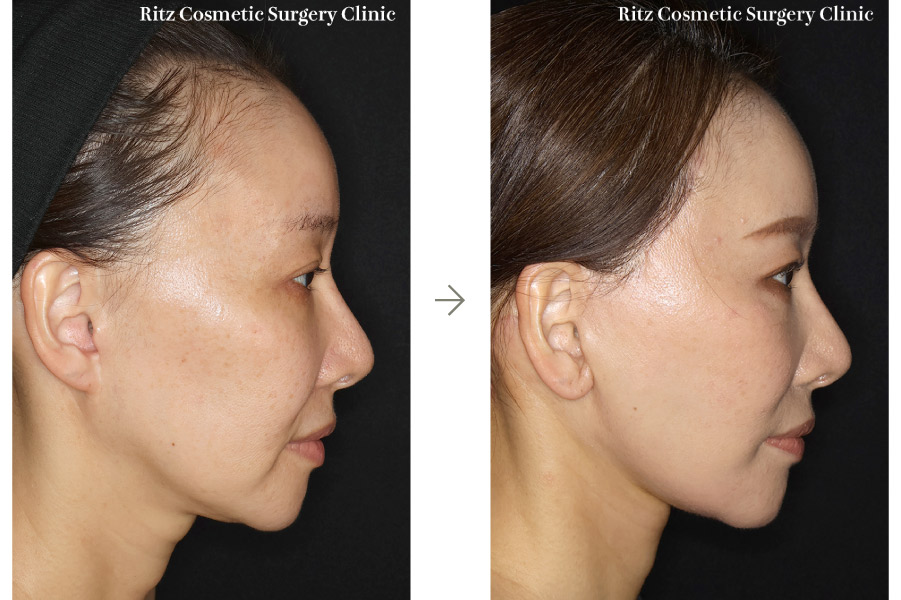 症例写真：フェイスネックリフト（Extended Deep Plane Facelift） ペリカン手術 脂肪吸引(ジョールファット)