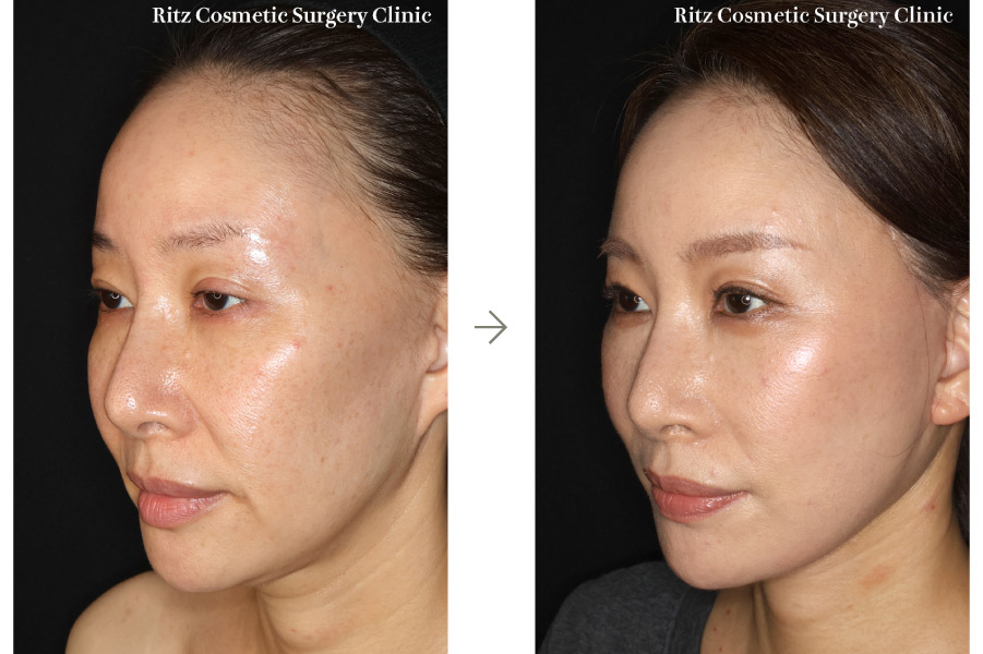 症例写真：フェイスネックリフト（Extended Deep Plane Facelift） ペリカン手術 脂肪吸引(ジョールファット)