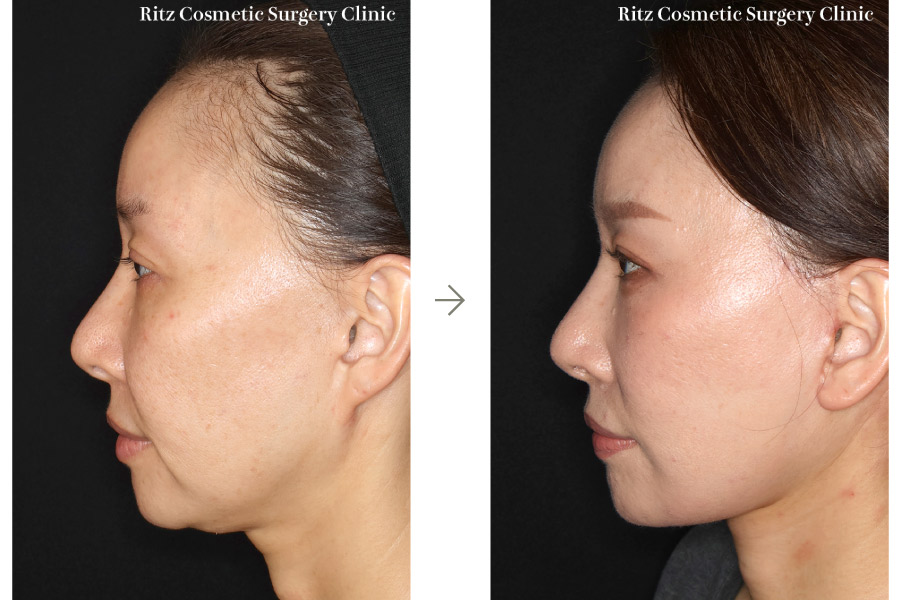症例写真：フェイスネックリフト（Extended Deep Plane Facelift） ペリカン手術 脂肪吸引(ジョールファット)