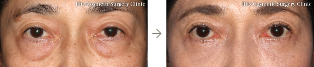 症例写真：裏ハムラ法（正面）