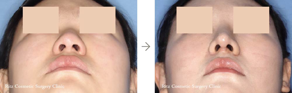 症例写真：鼻中隔延長術＋鼻シリコンインプラント(右側面)