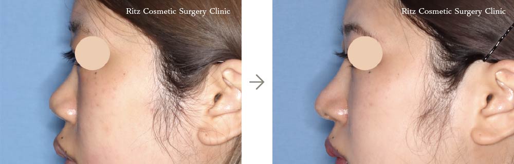 症例写真：鼻中隔延長術＋鼻シリコンインプラント(左側面)