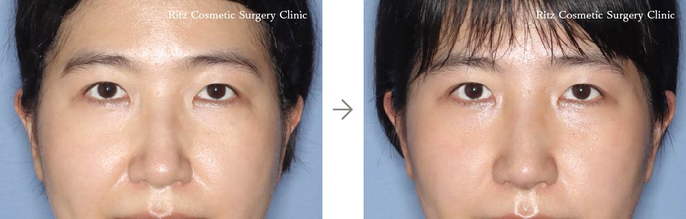症例写真：鼻中隔延長術＋鼻シリコンインプラント＋鼻骨骨切り術（ハンプ切除）（正面）