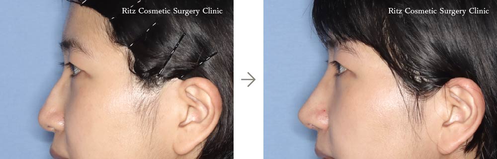症例写真：鼻中隔延長術＋鼻シリコンインプラント＋鼻骨骨切り術（ハンプ切除）（左側面）