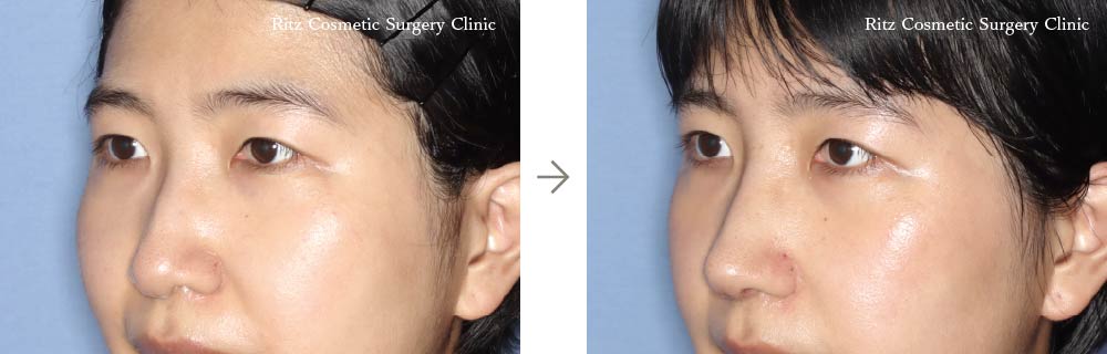 症例写真：鼻中隔延長術＋鼻シリコンインプラント＋鼻骨骨切り術（ハンプ切除）（左斜め）