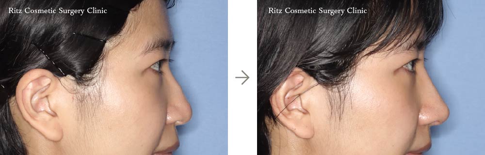 症例写真：鼻中隔延長術＋鼻シリコンインプラント＋鼻骨骨切り術（ハンプ切除）（右側面）