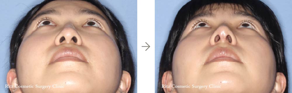 症例写真：鼻中隔延長術＋鼻シリコンインプラント＋鼻骨骨切り術（ハンプ切除）（仰ぐ）
