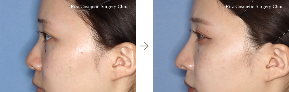 症例写真：鼻中隔延長術＋鼻シリコンインプラント(左側面)