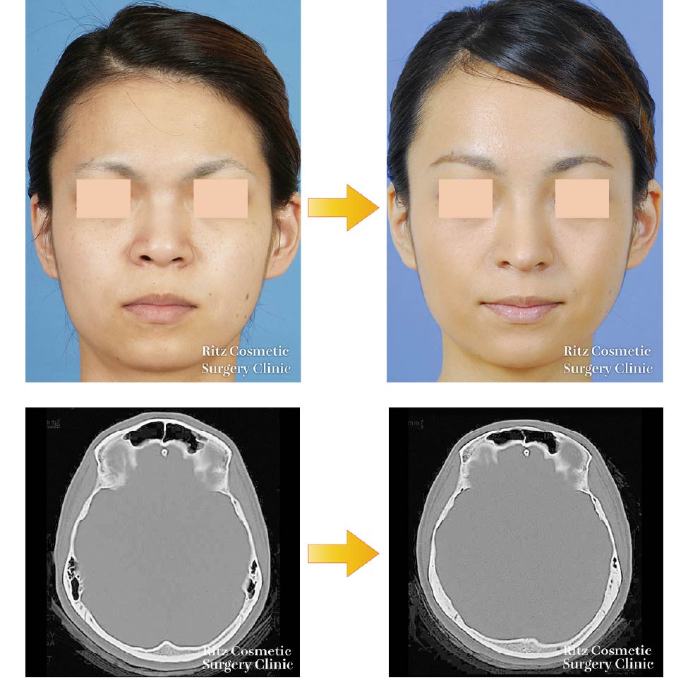 額(前頭部)の症例写真（前面）