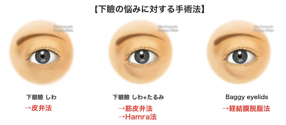 下眼の悩みに対する手術法　下眼瞼しわ→皮弁法、下眼瞼しわ＋たるみ→筋皮弁法、Hamra法、Baggy eyelids→経結膜脱脂法