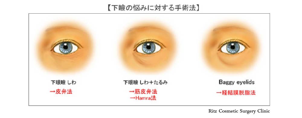 下眼の悩みに対する手術法　下眼瞼しわ→皮弁法、下眼瞼しわ＋たるみ→筋皮弁法、Hamra法、Baggy eyelids→経結膜脱脂法