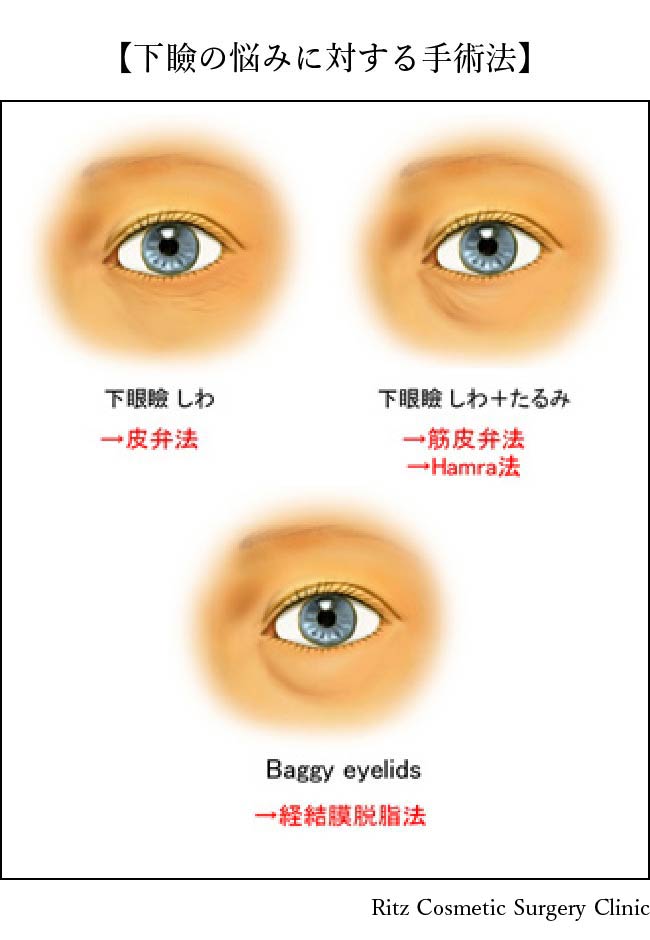 下眼の悩みに対する手術法　下眼瞼しわ→皮弁法、下眼瞼しわ＋たるみ→筋皮弁法、Hamra法、Baggy eyelids→経結膜脱脂法