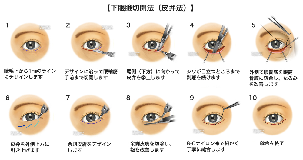 下眼瞼切開 (皮弁法)９つの手順