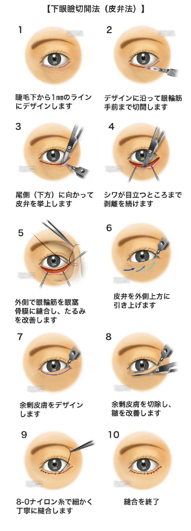 下眼瞼切開 (皮弁法)９つの手順