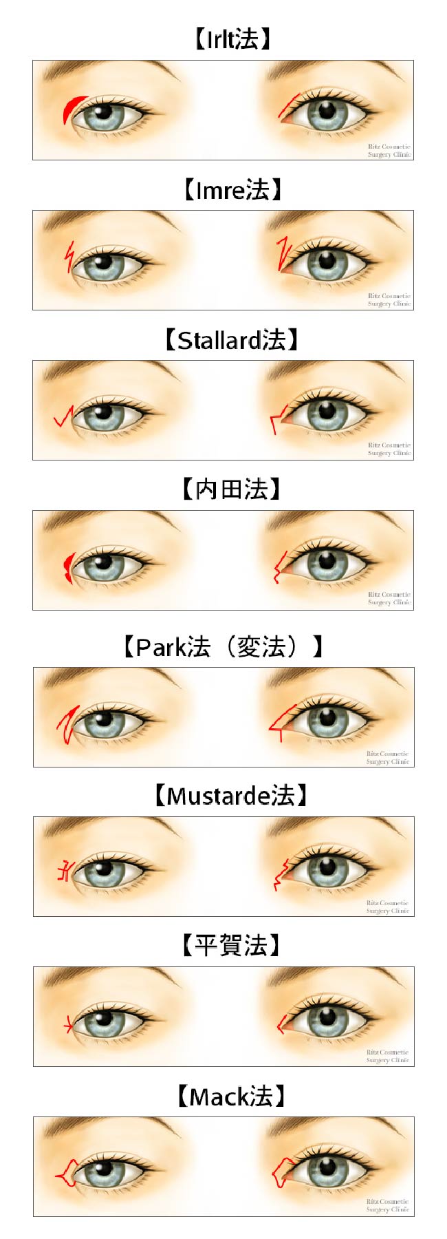 目頭切開の適応、Irlt法、Mustarde法、Imre法、平賀法、Stallard法、Mack法、内田法