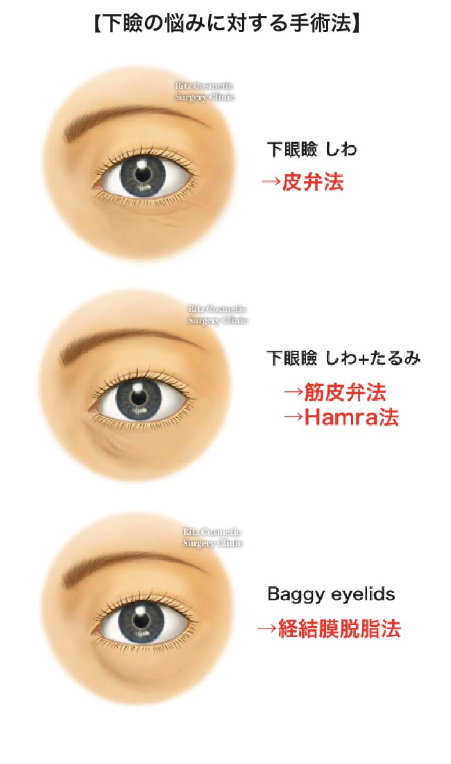 下眼瞼拡大(下制)術の術前・術後のイメージ