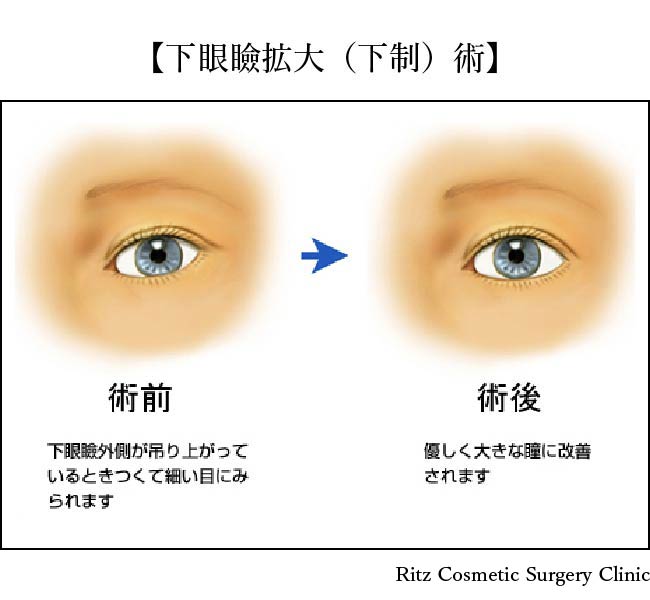 下眼瞼拡大 垂れ目形成 下眼瞼下制術 の美容整形 美容整形ならリッツ美容外科東京院