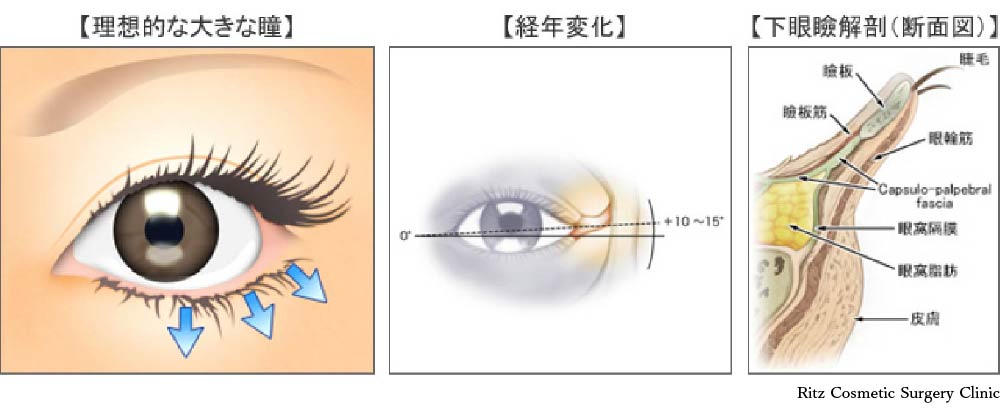 理想的な大きな瞳、経年劣化、下眼瞼解剖(断面図)