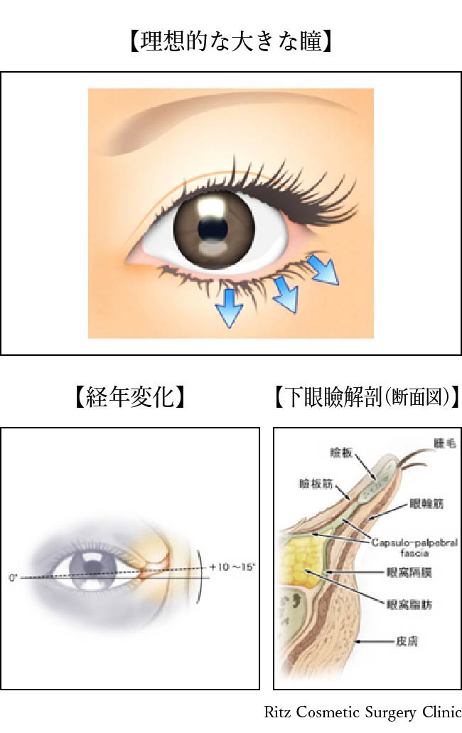 理想的な大きな瞳、経年劣化、下眼瞼解剖(断面図)