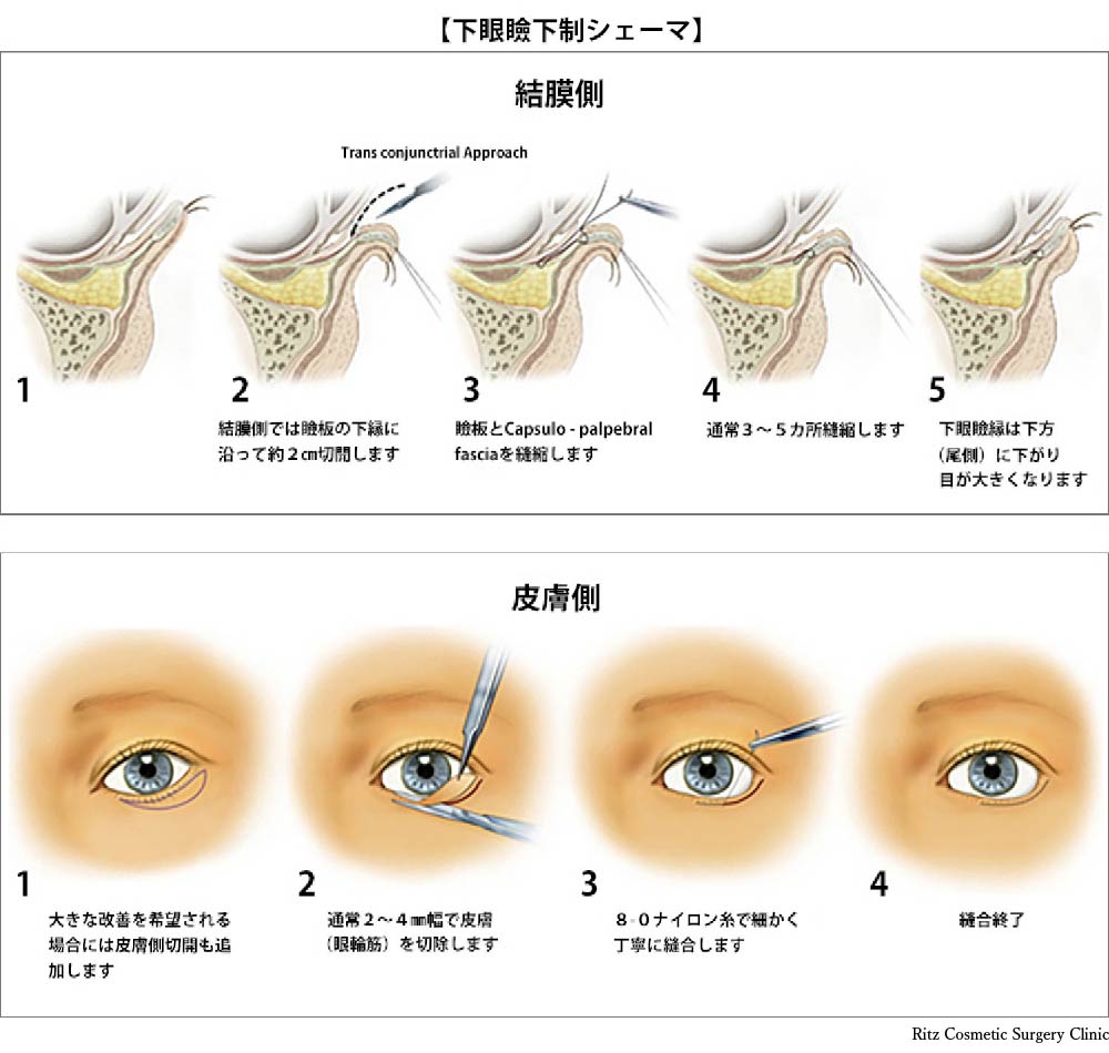 下眼瞼下制シェーマ　結膜側5つの手順、皮膚側５つの手順