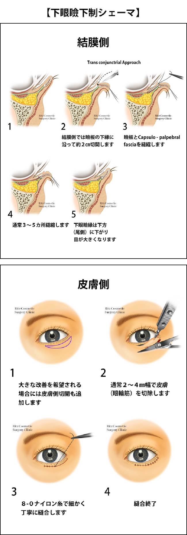 下眼瞼下制シェーマ　結膜側5つの手順、皮膚側５つの手順