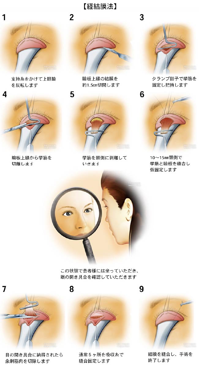 経結膜法９つの手順