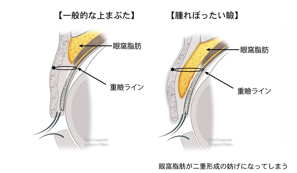 一般的な上まぶたと腫れぼったい瞼