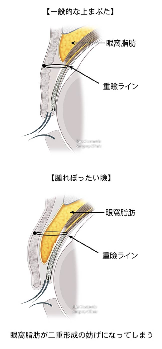 一般的な上まぶたと腫れぼったい瞼