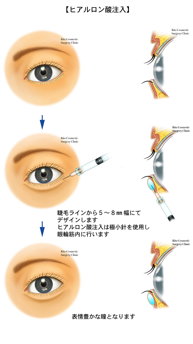 涙堂形ヒアルロン酸注入方法成